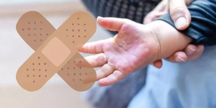 ¿Cómo tratar una quemadura de segundo grado en niños?