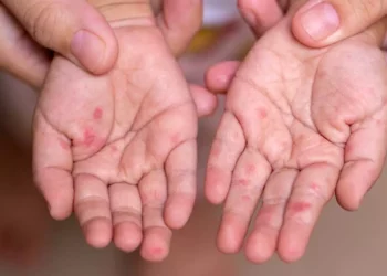 Daños a un menor causado por el virus Coxsackie.