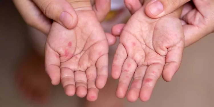 Daños a un menor causado por el virus Coxsackie.