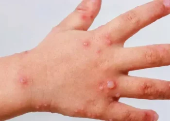 Alertan por propagación del virus Coxsackie entre menores de edad