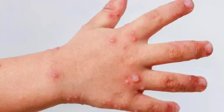 Alertan por propagación del virus Coxsackie entre menores de edad