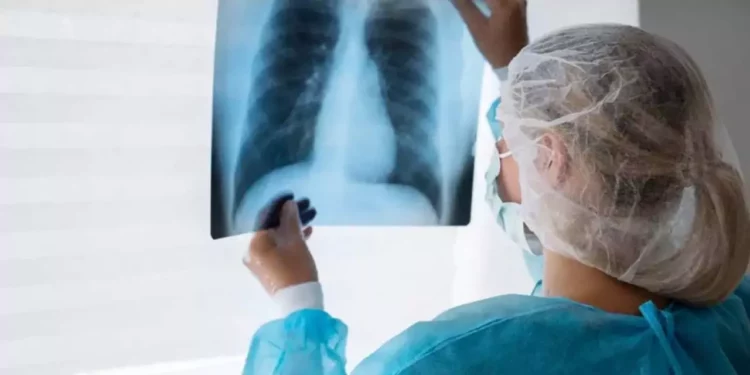 Foto: ilustrativa // La Secretaría de Salud federal asegura que, en el país, “el 80% de los pacientes con cáncer de pulmón tienen antecedentes de consumo crónico de tabaco.