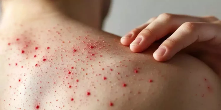 Foto; ilustrativa // Entre los síntomas más comunes del sarampión se encuentran: fiebre, congestión nasal, ojos rojos o irritados, manchas pequeñas dentro de la boca, erupción en la piel, que comienza en la cara y se extiende al cuerpo.