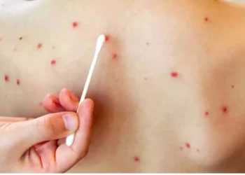 Sarampión es más contagioso que el COVID-19: Salud alerta y refuerza vacunación en México