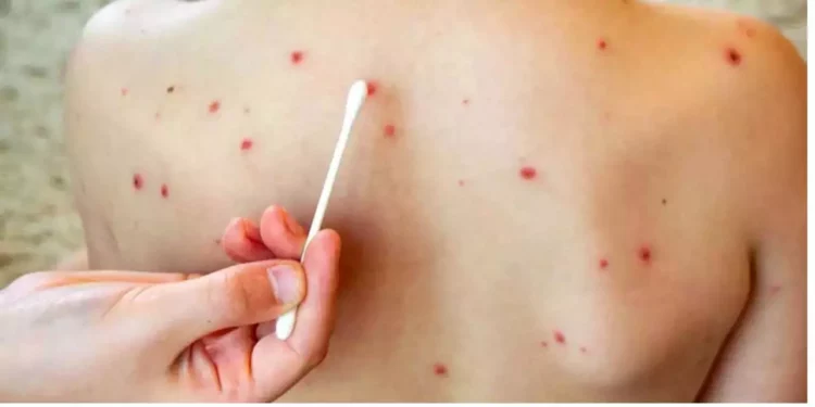 Sarampión es más contagioso que el COVID-19: Salud alerta y refuerza vacunación en México