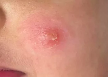Concluye Oaxaca 2025 con tres casos de Leishmaniasis cutánea