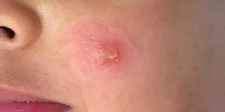 Concluye Oaxaca 2025 con tres casos de Leishmaniasis cutánea