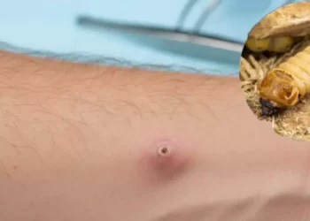 Foto: Agencias // Lesión dejada por el gusano barrenador en la piel humana.