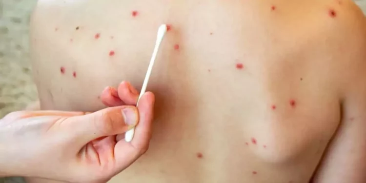 Foto: internet // Cualquier persona entre 6 meses y 49 años que no esté segura de haber recibido su dosis o que no tenga el esquema completo debe acudir a vacunarse.
