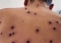 Foto: internet – ilustrativa // Los principales síntomas de la viruela símica son fiebre, dolores musculares, inflamación de los ganglios linfáticos y un sarpullido doloroso.