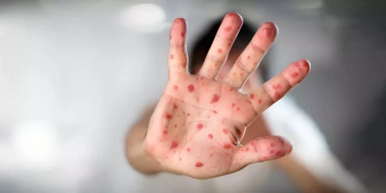 Foto: ilustrativa // De esta enfermedad, el sector salud recordó que las señales más comunes son la fiebre, congestión nasal, ojos rojos o irritados, manchas pequeñas dentro de la boca y erupción en la piel.