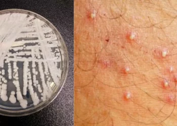 ¿Qué es Candida auris? La “superbacteria” fúngica que tiene en alerta a hospitales en EE. UU.