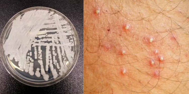 ¿Qué es Candida auris? La “superbacteria” fúngica que tiene en alerta a hospitales en EE. UU.