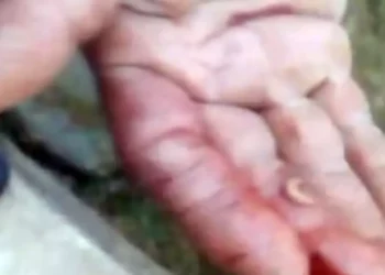 Foto: Tomada de video // Familiares del hombre infectado muestran un gusano barrenador.