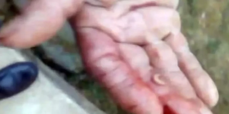 Foto: Tomada de video // Familiares del hombre infectado muestran un gusano barrenador.