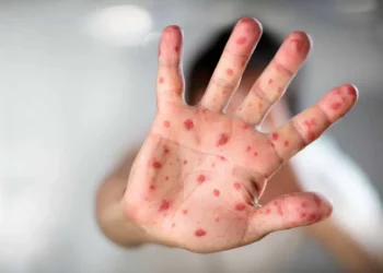 Foto: archivo // La Secretaría de Salud federal señala 57 casos de sarampión en el periodo 2025-2026, sin reporte de decesos como sí ha sucedido en otros estados.