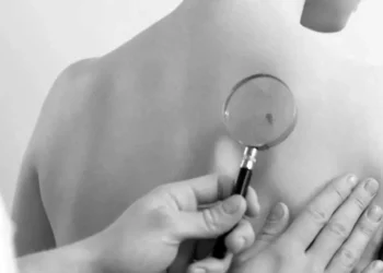 Cáncer de piel, Oaxaca entre los estados más afectados