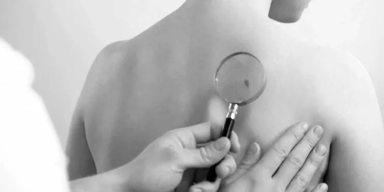 Cáncer de piel, Oaxaca entre los estados más afectados