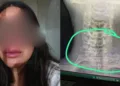Doctora denuncia golpiza en alcoholímetro y desata ola de indignación contra policías de Santa Cruz Amilpas