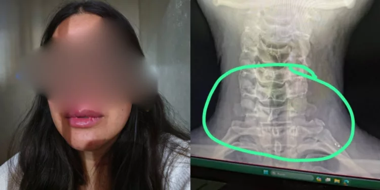 Doctora denuncia golpiza en alcoholímetro y desata ola de indignación contra policías de Santa Cruz Amilpas