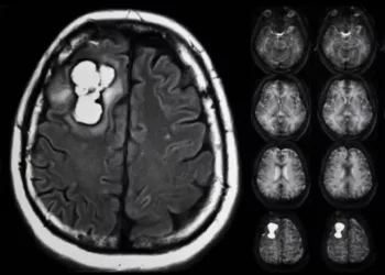 Foto: internet – ilustrativa // Aumentan decesos por tumores malignos del cerebro.