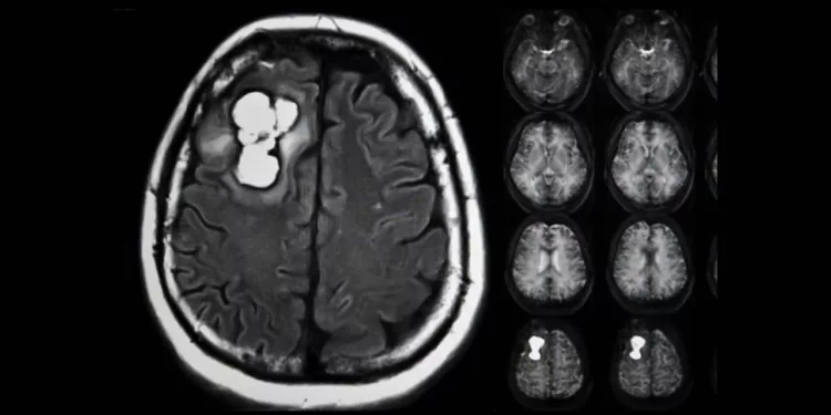 Foto: internet – ilustrativa // Aumentan decesos por tumores malignos del cerebro.
