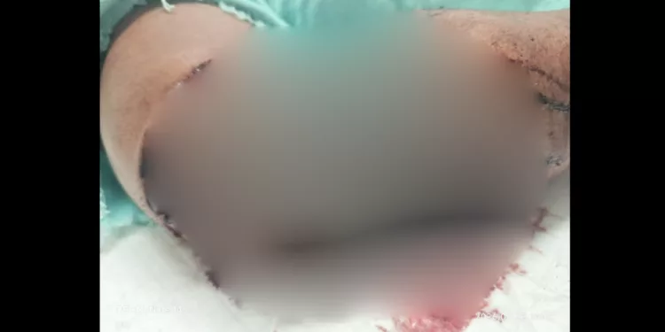 Mujer queda al borde de perder el brazo tras ataque de Pitbull en Huajuapan