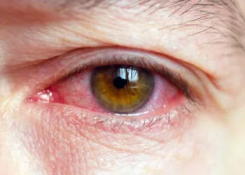 Oaxaca en octavo lugar por casos de conjuntivitis