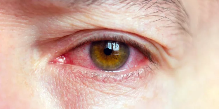 Oaxaca en octavo lugar por casos de conjuntivitis