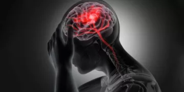 El ataque cerebral se desarrolla como resultado de una acumulación progresiva de factores de riesgo.