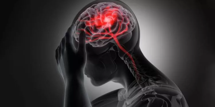 El ataque cerebral se desarrolla como resultado de una acumulación progresiva de factores de riesgo.